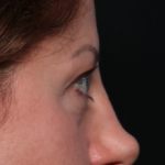 Blepharoplasty and Brow Lift Before & After Patient #34363